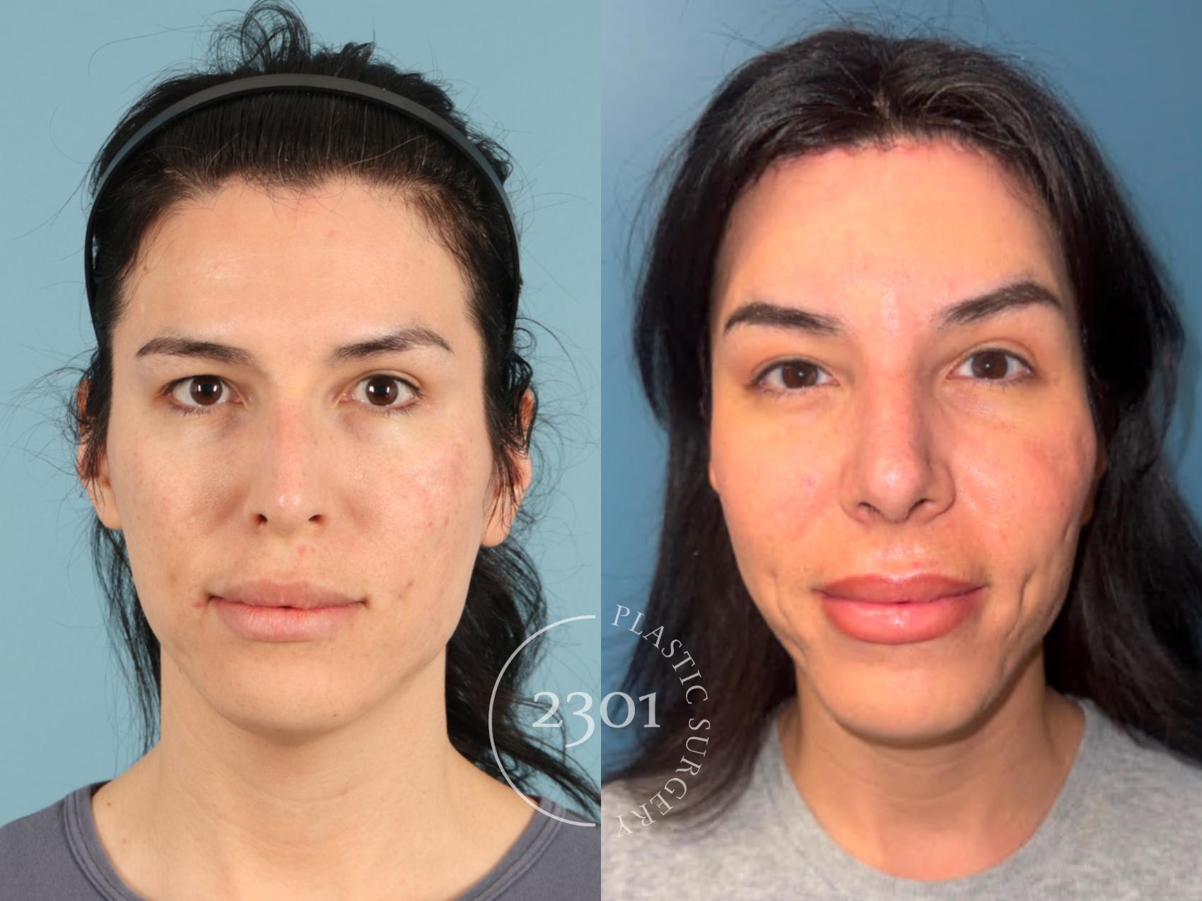 Before & After Rhinoplasty Case 951 Front View in Fort Worth, Plano, & Frisco, Texas