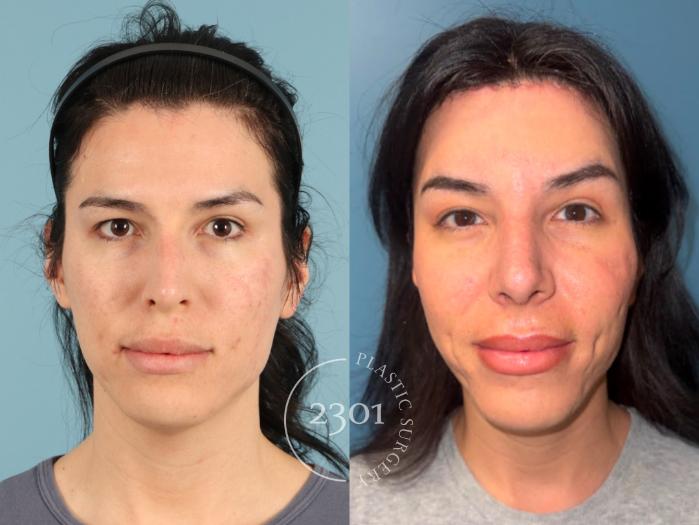 Before & After Rhinoplasty Case 951 Front View in Fort Worth, Plano, & Frisco, Texas