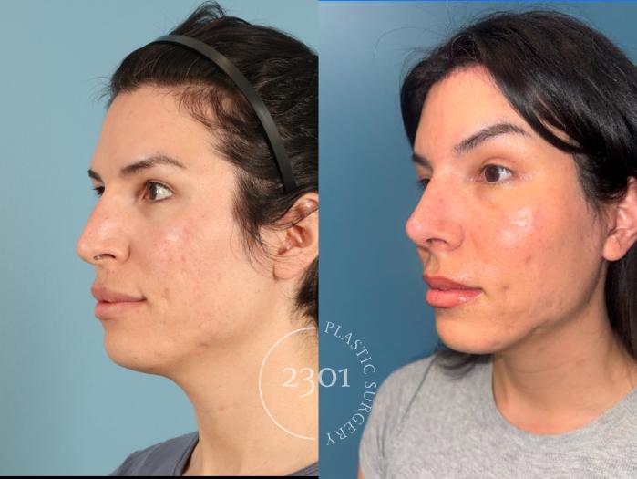 Before & After Rhinoplasty Case 951 Left Oblique View in Fort Worth, Plano, & Frisco, Texas
