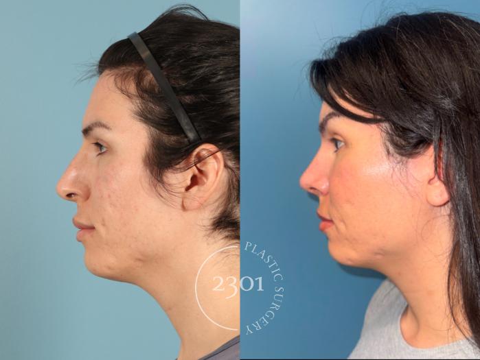 Before & After Rhinoplasty Case 951 Left Side View in Fort Worth, Plano, & Frisco, Texas