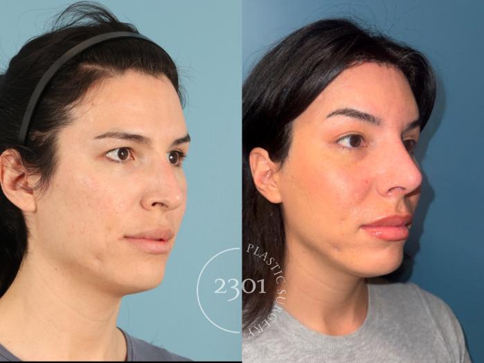 Before & After Rhinoplasty Case 951 Right Oblique View in Fort Worth, Plano, & Frisco, Texas