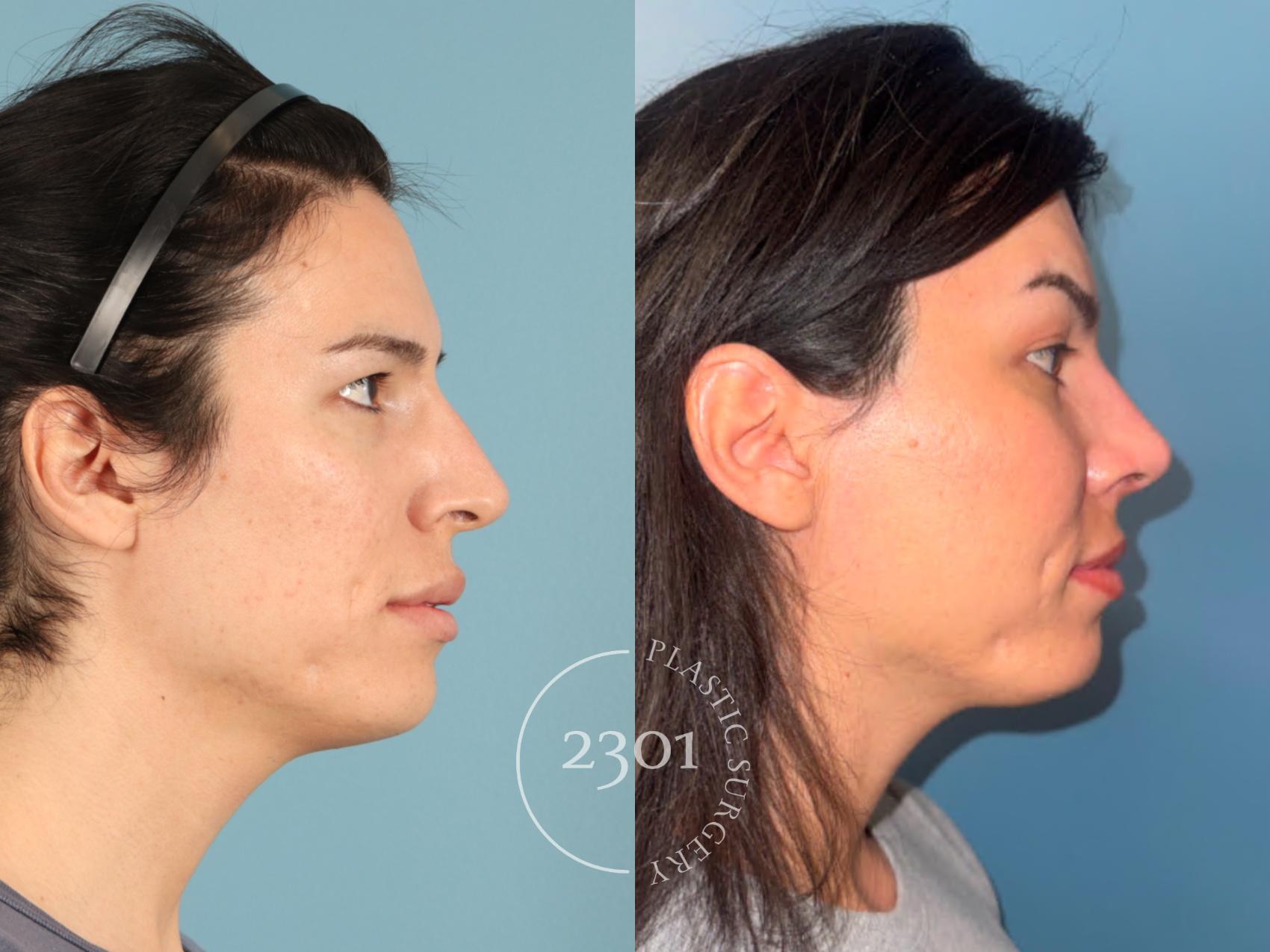 Before & After Rhinoplasty Case 951 Right Side View in Fort Worth, Plano, & Frisco, Texas