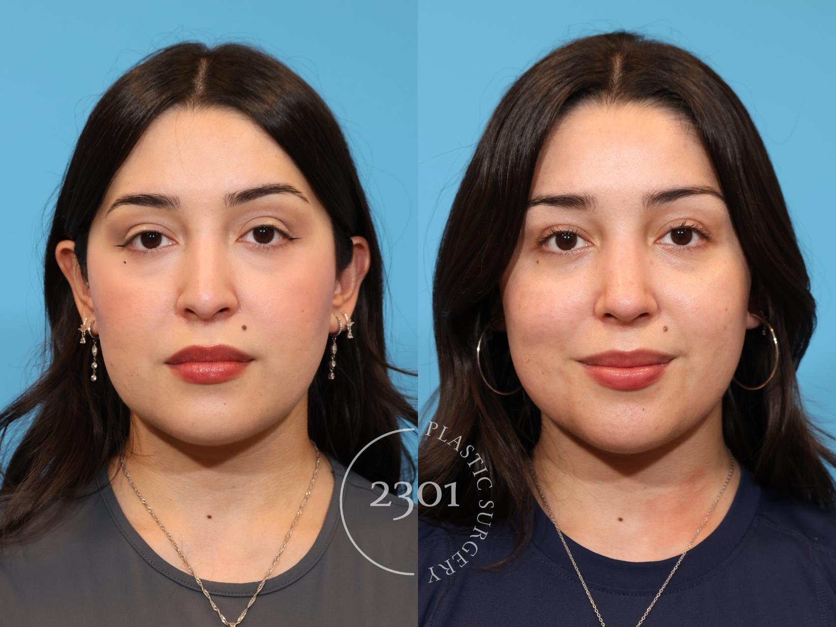 Before & After Rhinoplasty Case 977 Front View in Fort Worth, Plano, & Frisco, Texas