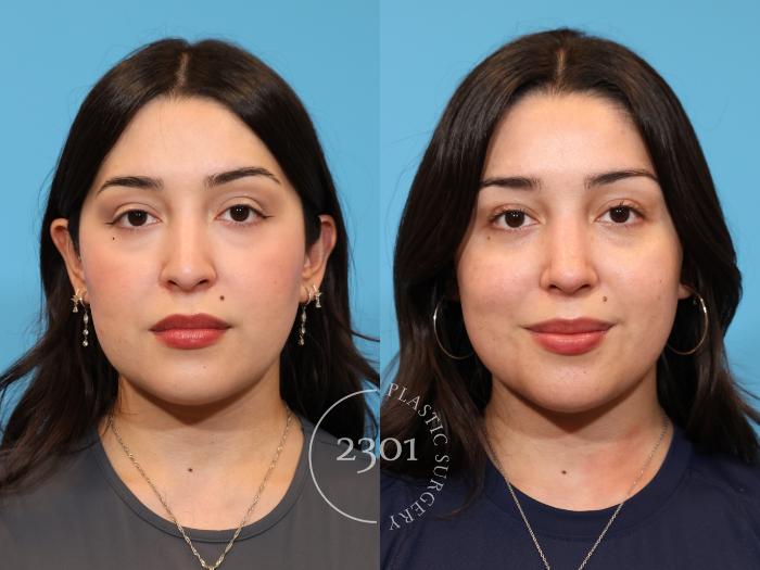 Before & After Rhinoplasty Case 977 Front View in Fort Worth, Plano, & Frisco, Texas