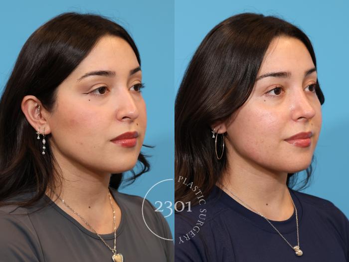 Before & After Rhinoplasty Case 977 Left Oblique View in Fort Worth, Plano, & Frisco, Texas