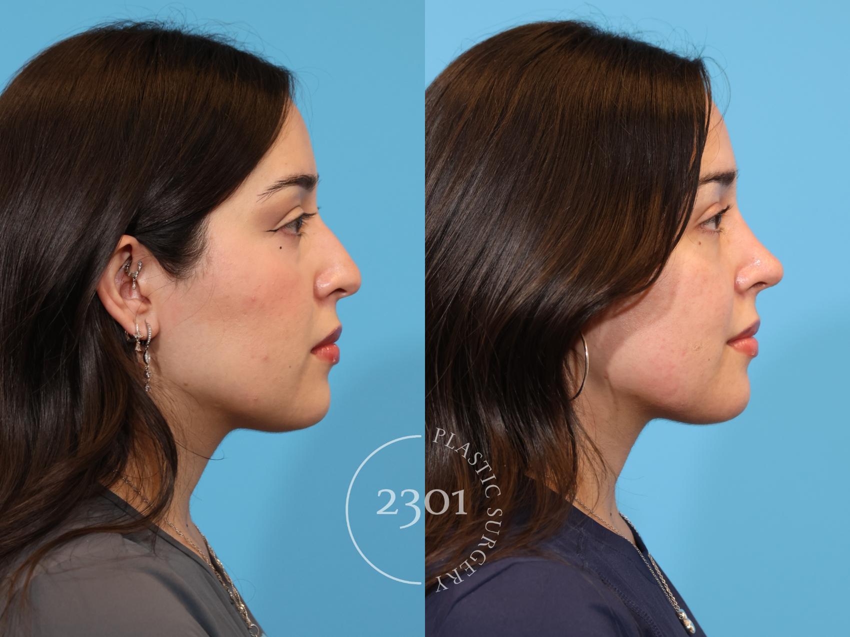 Before & After Rhinoplasty Case 977 Right Side View in Fort Worth, Plano, & Frisco, Texas