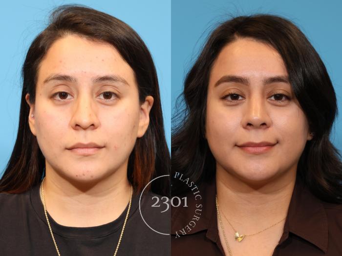 Before & After Rhinoplasty Case 978 Front View in Fort Worth, Plano, & Frisco, Texas