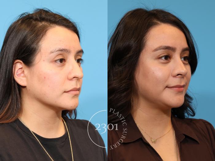 Before & After Rhinoplasty Case 978 Right Oblique View in Fort Worth, Plano, & Frisco, Texas