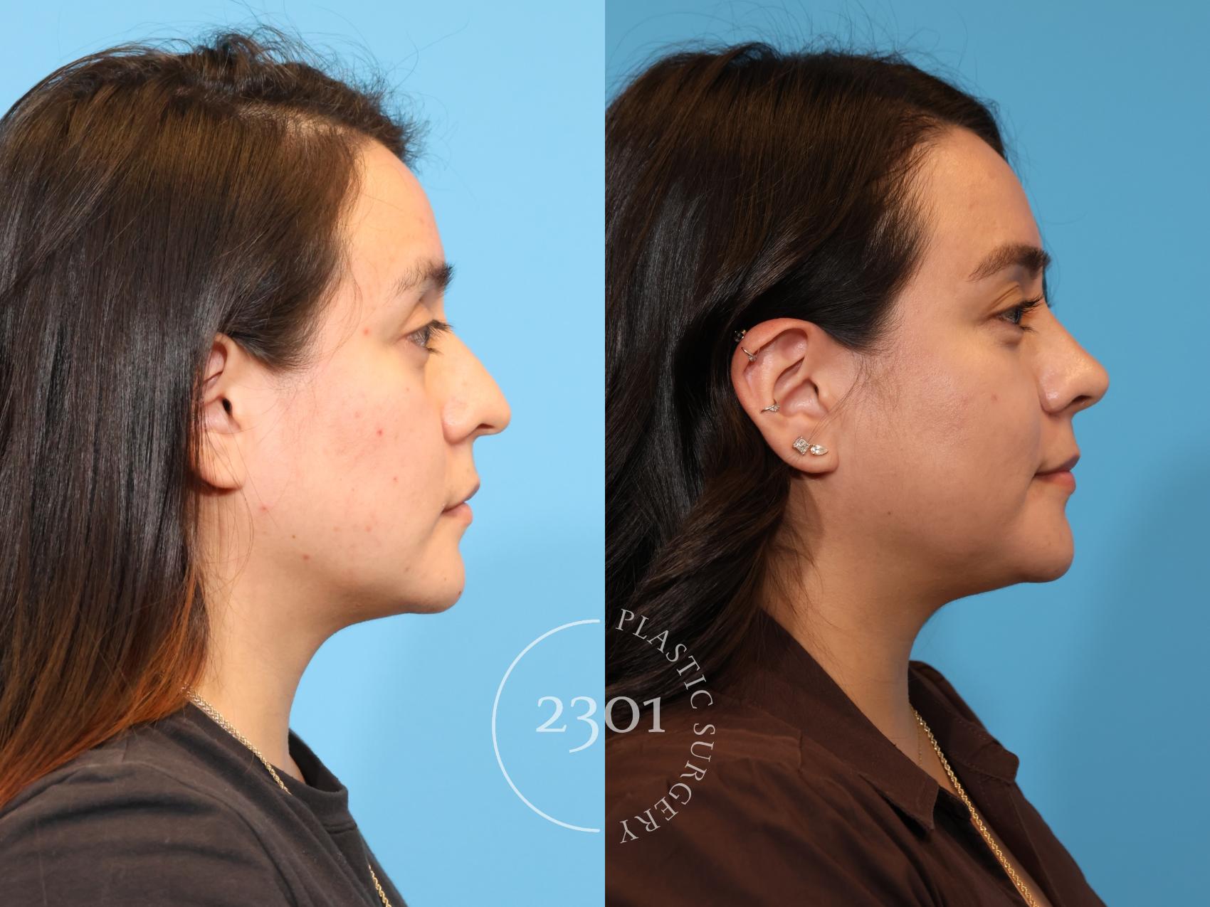 Before & After Rhinoplasty Case 978 Right Side View in Fort Worth, Plano, & Frisco, Texas