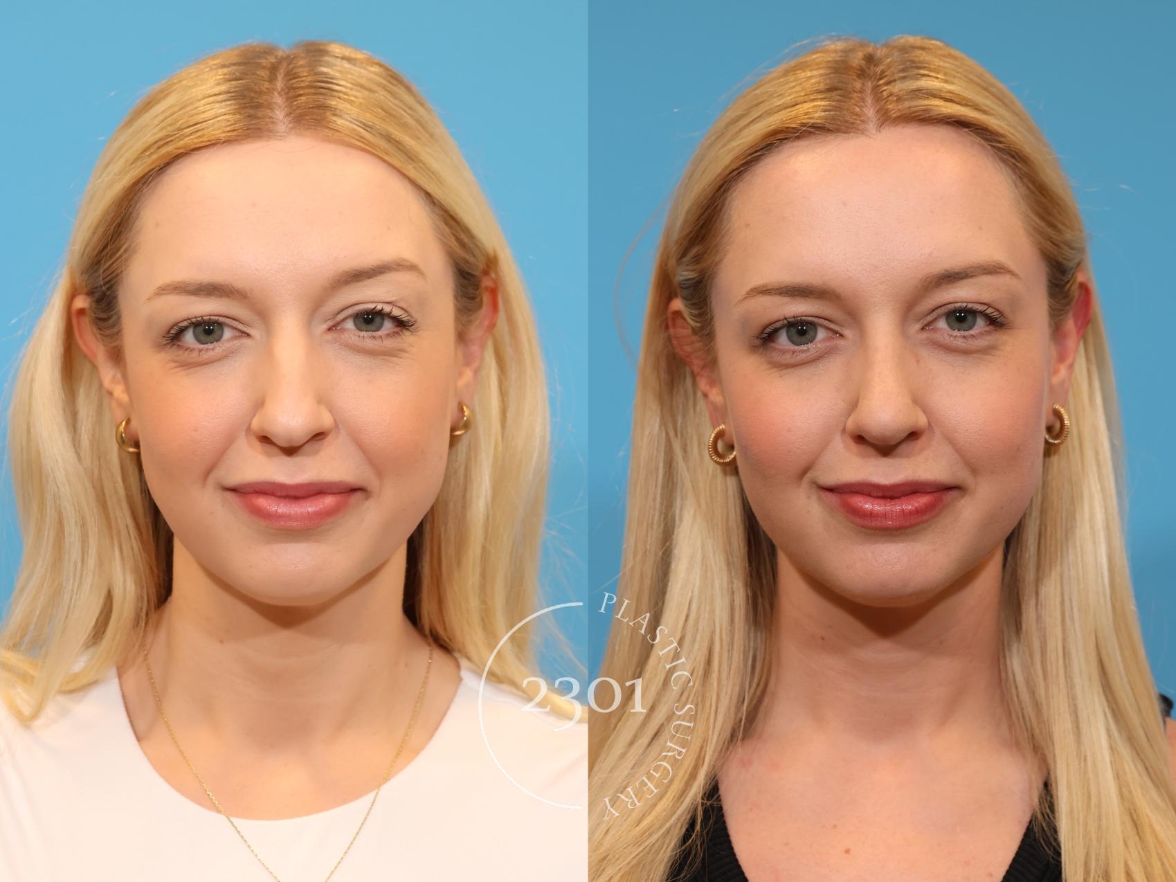 Before & After Rhinoplasty Case 979 Front View in Fort Worth, Plano, & Frisco, Texas