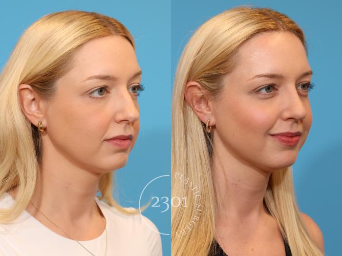 Before & After Rhinoplasty Case 979 Right Oblique View in Fort Worth, Plano, & Frisco, Texas