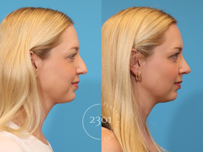 Before & After Rhinoplasty Case 979 Right Side View in Fort Worth, Plano, & Frisco, Texas