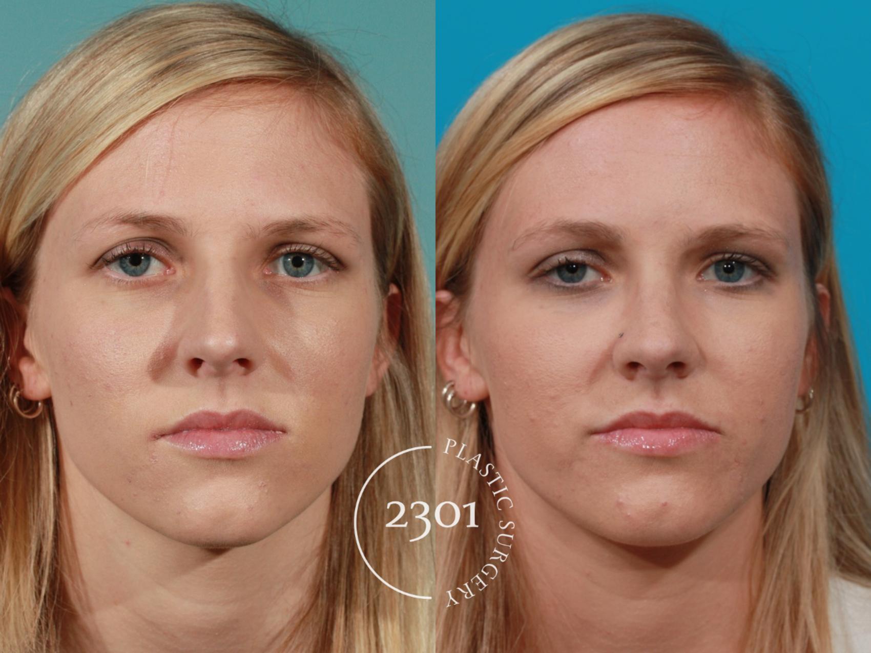 Before & After Rhinoplasty Case 98 View #1 View in Fort Worth, Plano, & Frisco, Texas