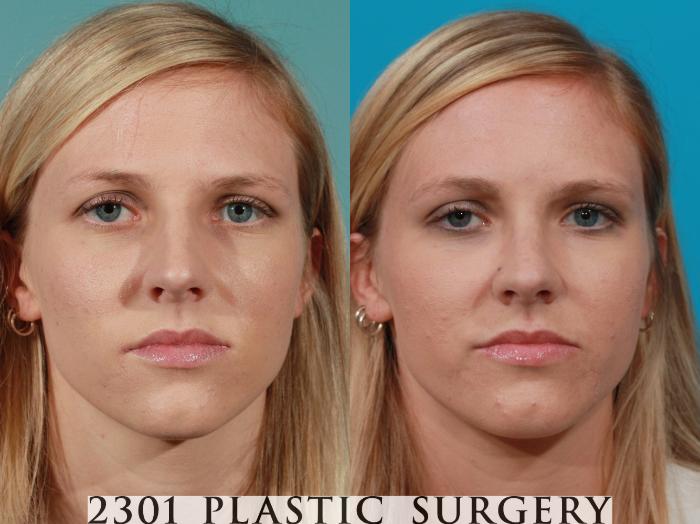 Before & After Rhinoplasty Case 98 View #1 View in Fort Worth, Plano, & Frisco, Texas