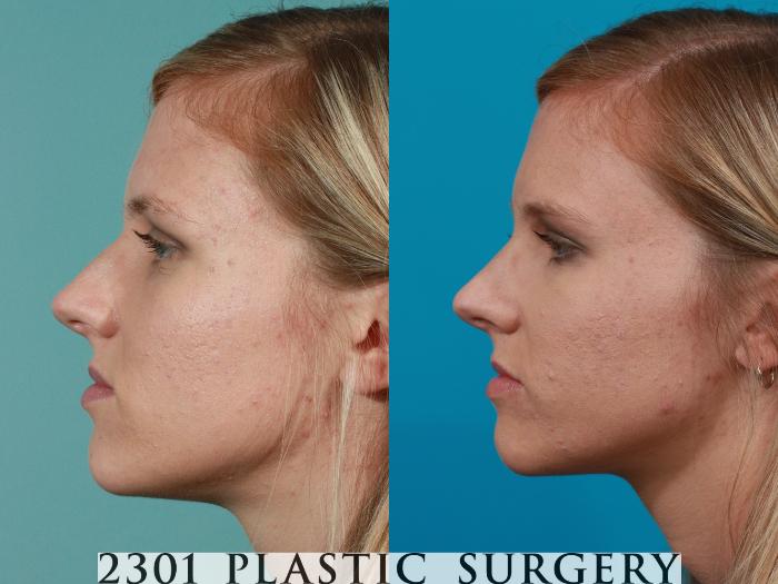 Before & After Rhinoplasty Case 98 View #2 View in Fort Worth, Plano, & Frisco, Texas