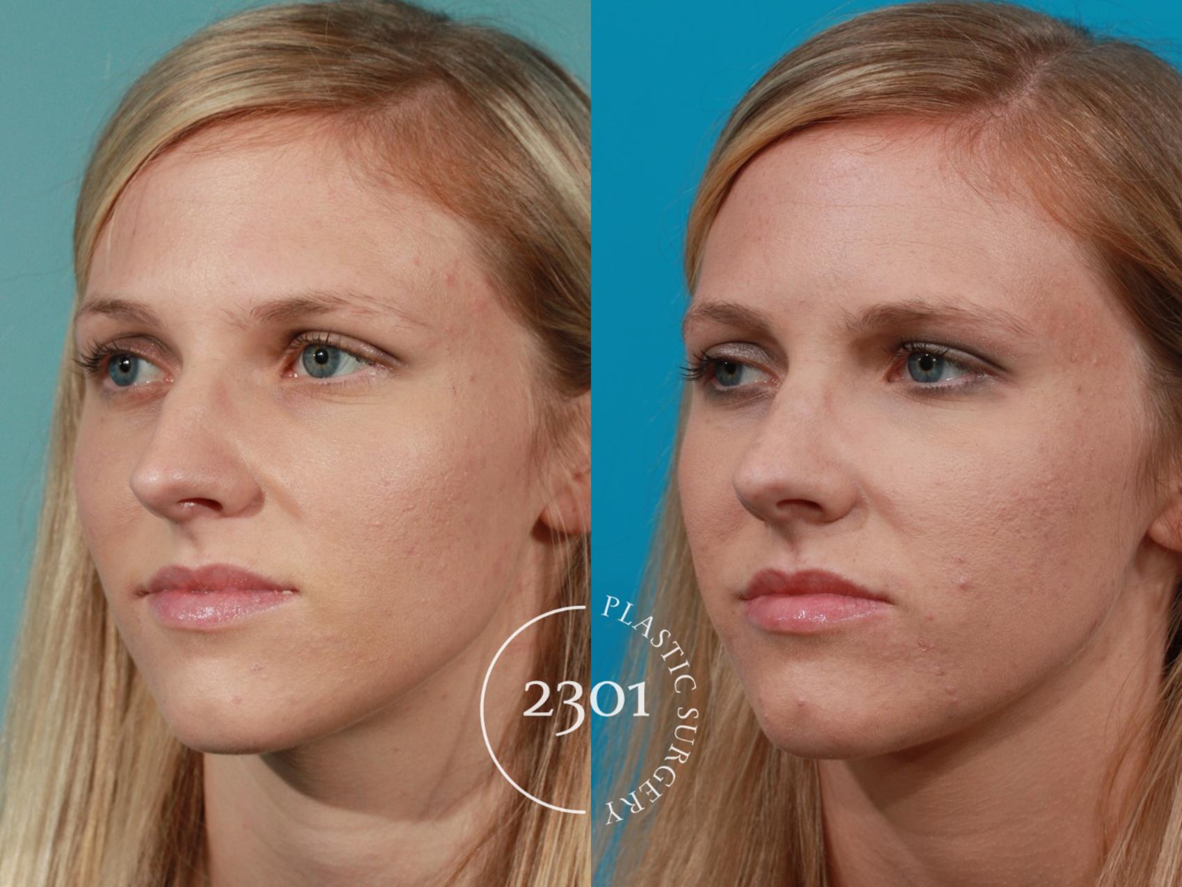 Before & After Rhinoplasty Case 98 View #3 View in Fort Worth, Plano, & Frisco, Texas