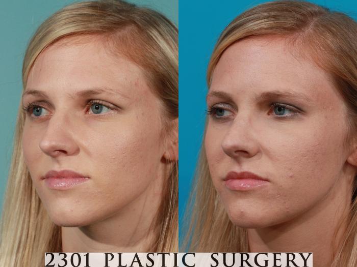 Before & After Rhinoplasty Case 98 View #3 View in Fort Worth, Plano, & Frisco, Texas