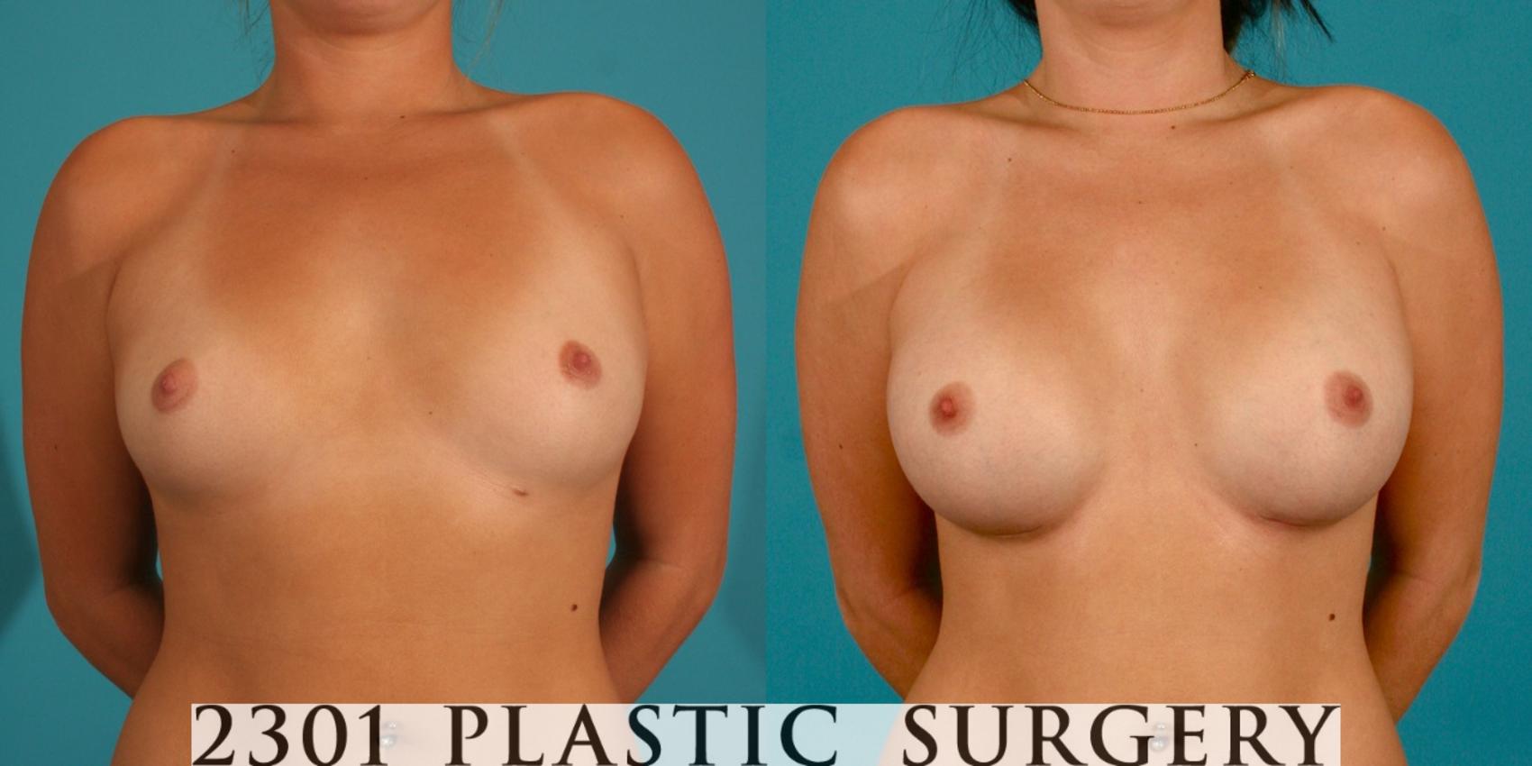 Before & After Breast Augmentation Case 1 View #1 View in Fort Worth, Plano, & Frisco, Texas