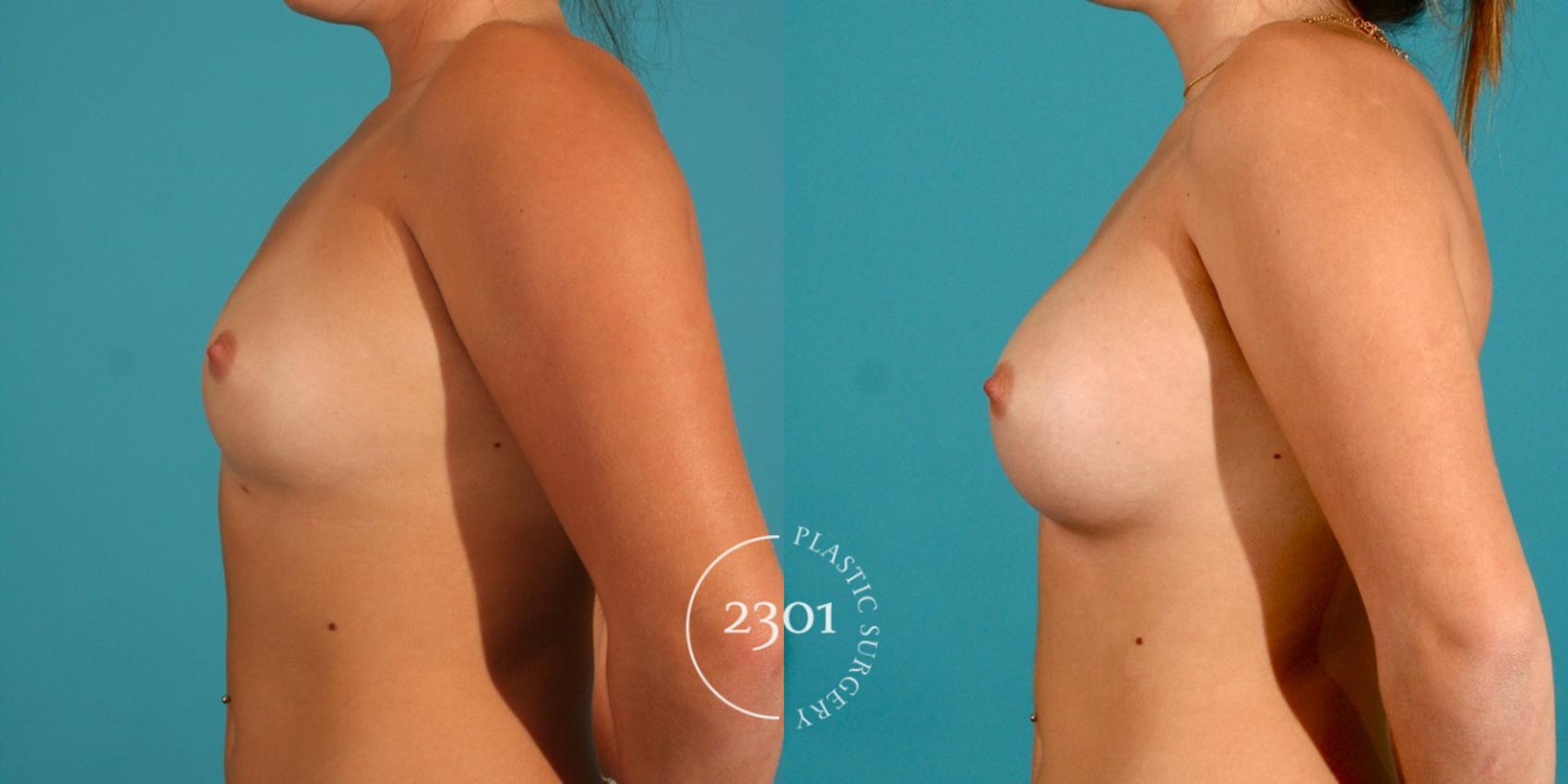 Before & After Saline Implants Case 1 View #2 View in Fort Worth, Plano, & Frisco, Texas
