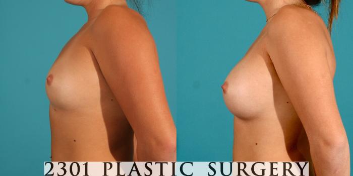 Before & After Breast Augmentation Case 1 View #2 View in Fort Worth, Plano, & Frisco, Texas