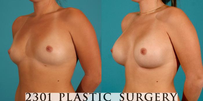 Before & After Saline Implants Case 1 View #3 View in Fort Worth, Plano, & Frisco, Texas