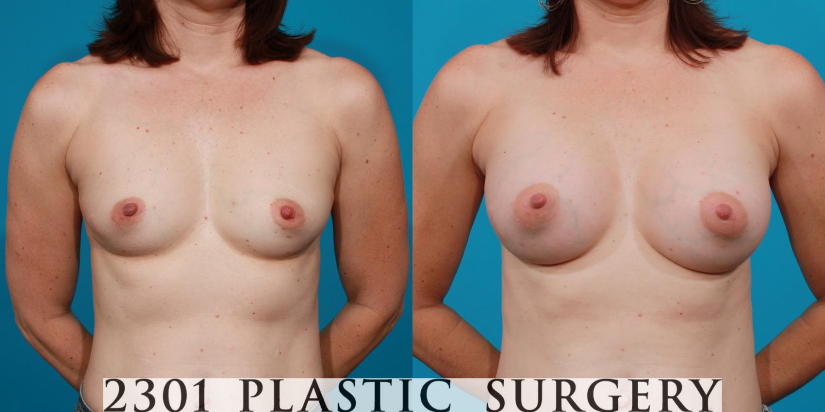 Before & After Saline Implants Case 107 View #1 View in Fort Worth, Plano, & Frisco, Texas