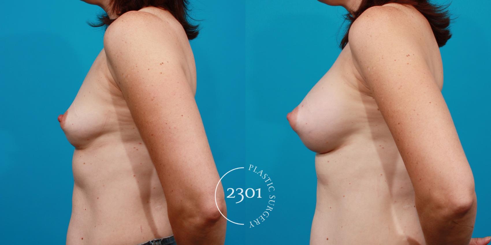 Before & After Saline Implants Case 107 View #2 View in Fort Worth, Plano, & Frisco, Texas