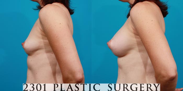 Before & After Saline Implants Case 107 View #2 View in Fort Worth, Plano, & Frisco, Texas