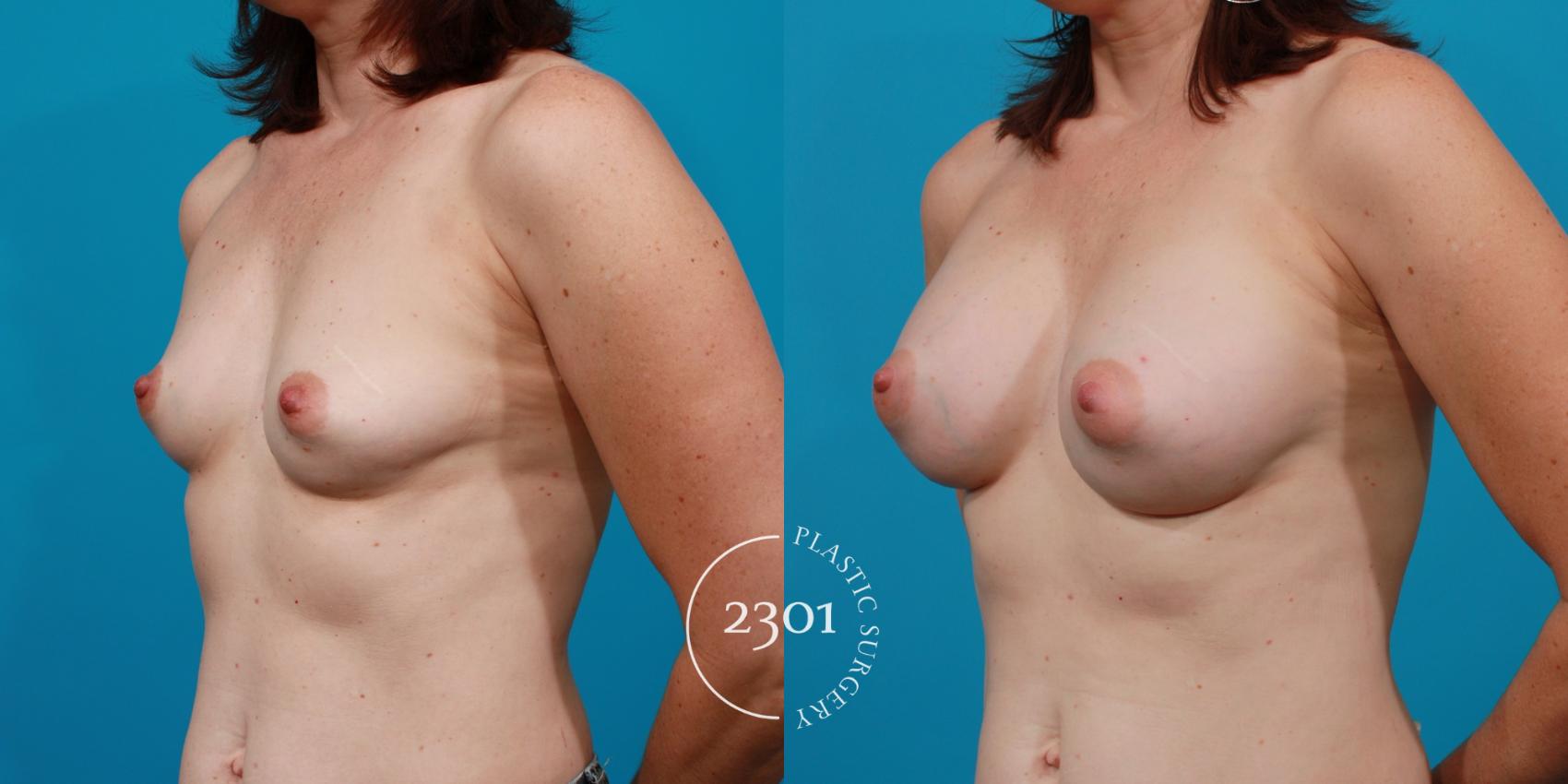 Before & After Saline Implants Case 107 View #3 View in Fort Worth, Plano, & Frisco, Texas