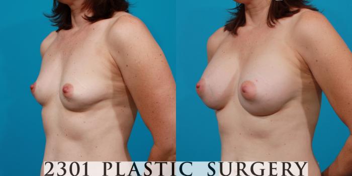 Before & After Saline Implants Case 107 View #3 View in Fort Worth, Plano, & Frisco, Texas