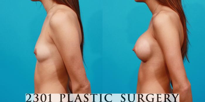 Before & After Saline Implants Case 123 View #2 View in Fort Worth, Plano, & Frisco, Texas