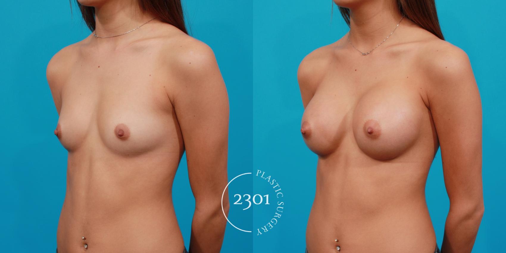 Before & After Saline Implants Case 123 View #3 View in Fort Worth, Plano, & Frisco, Texas