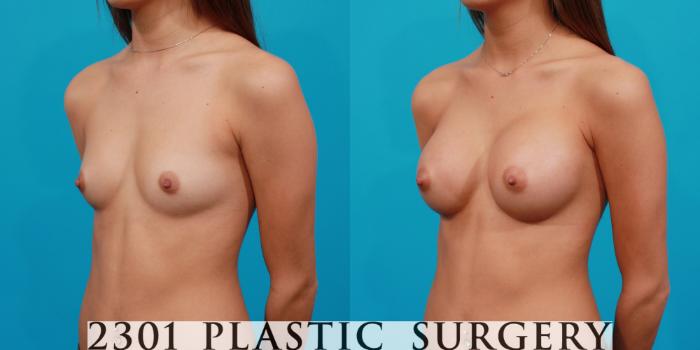 Before & After Breast Augmentation Case 123 View #3 View in Fort Worth, Plano, & Frisco, Texas