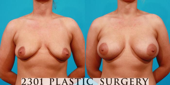 Before & After Saline Implants Case 127 View #1 View in Fort Worth, Plano, & Frisco, Texas