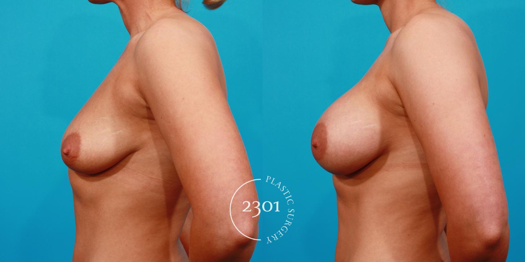 Before & After Saline Implants Case 127 View #2 View in Fort Worth, Plano, & Frisco, Texas