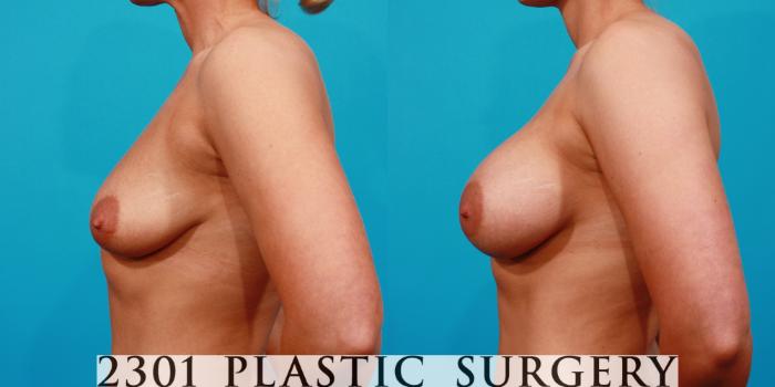 Before & After Saline Implants Case 127 View #2 View in Fort Worth, Plano, & Frisco, Texas