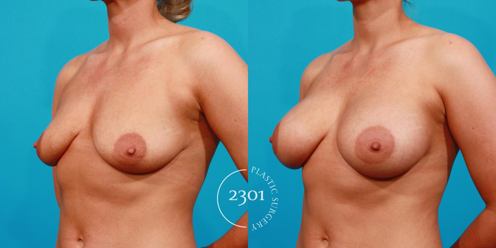 Before & After Saline Implants Case 127 View #3 View in Fort Worth, Plano, & Frisco, Texas