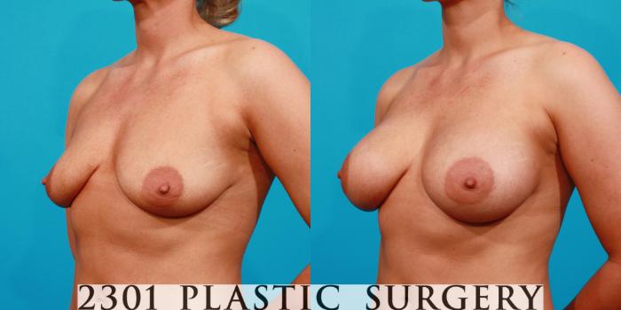 Before & After Saline Implants Case 127 View #3 View in Fort Worth, Plano, & Frisco, Texas