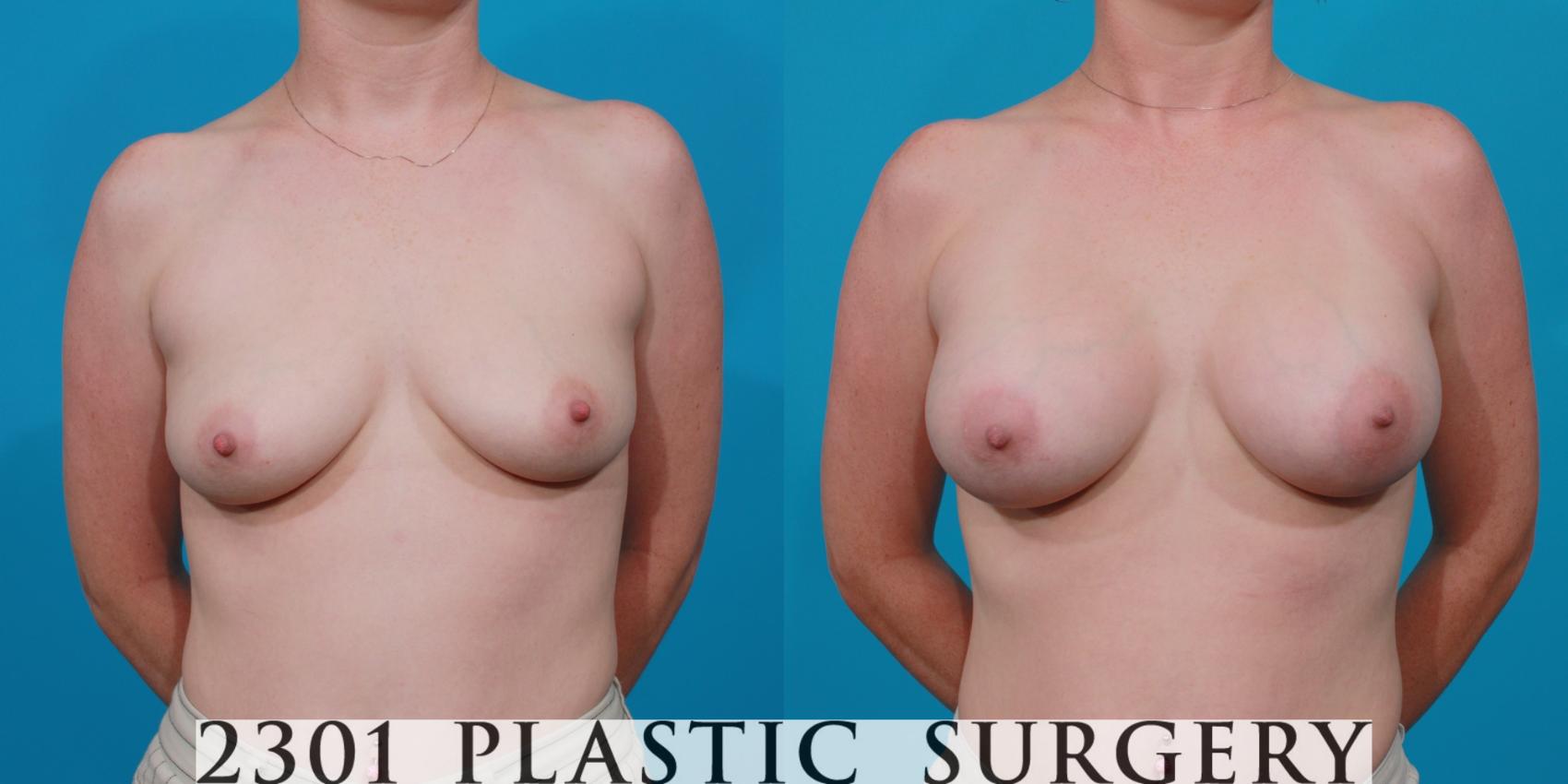 Before & After Saline Implants Case 140 View #1 View in Fort Worth, Plano, & Frisco, Texas