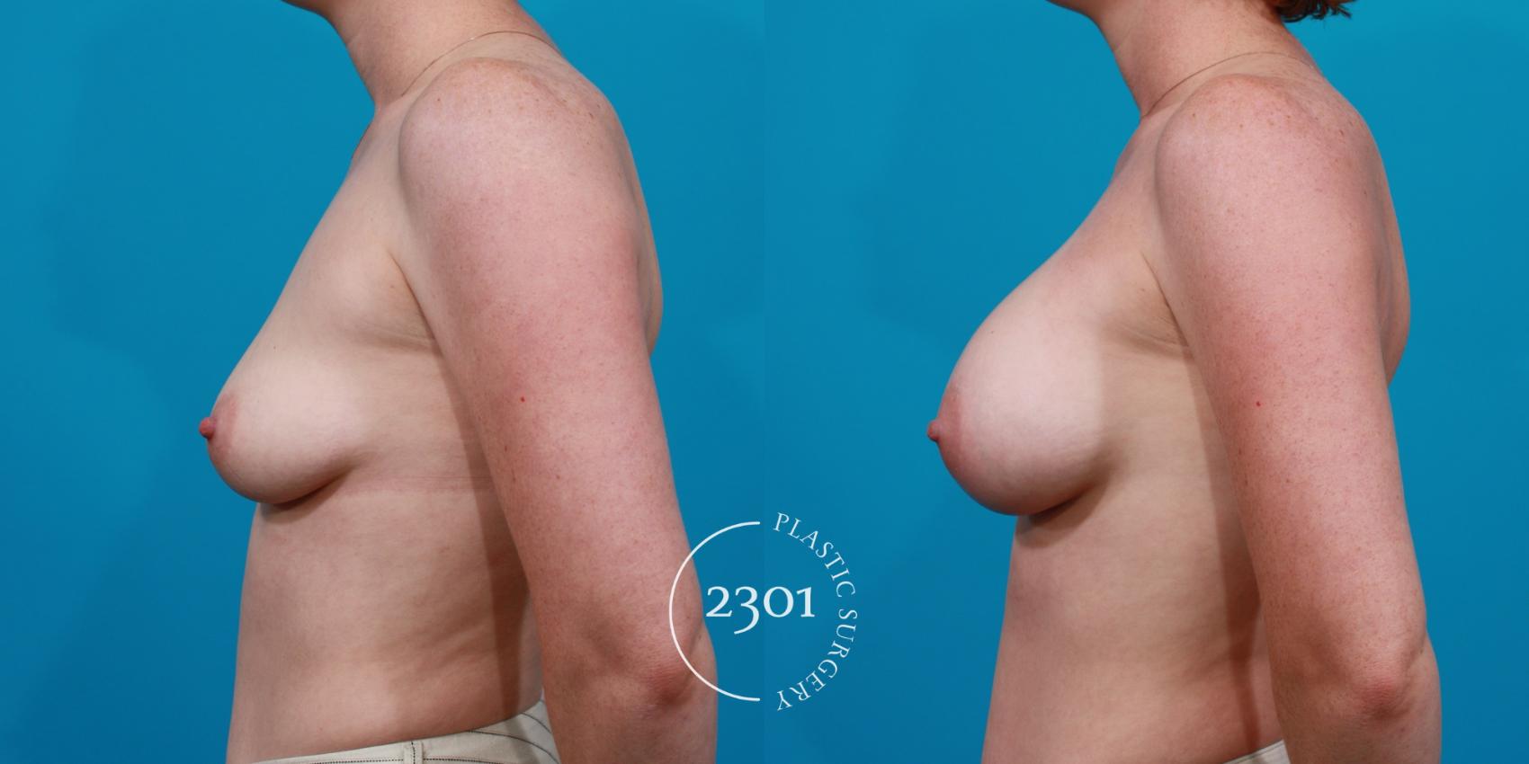 Before & After Saline Implants Case 140 View #2 View in Fort Worth, Plano, & Frisco, Texas