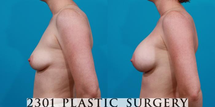 Before & After Saline Implants Case 140 View #2 View in Fort Worth, Plano, & Frisco, Texas