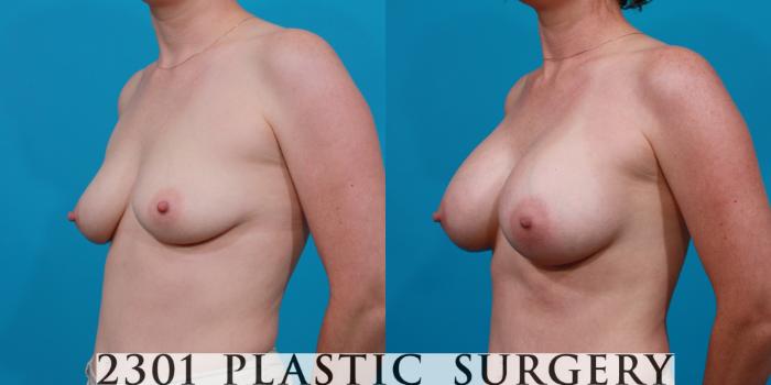 Before & After Saline Implants Case 140 View #3 View in Fort Worth, Plano, & Frisco, Texas