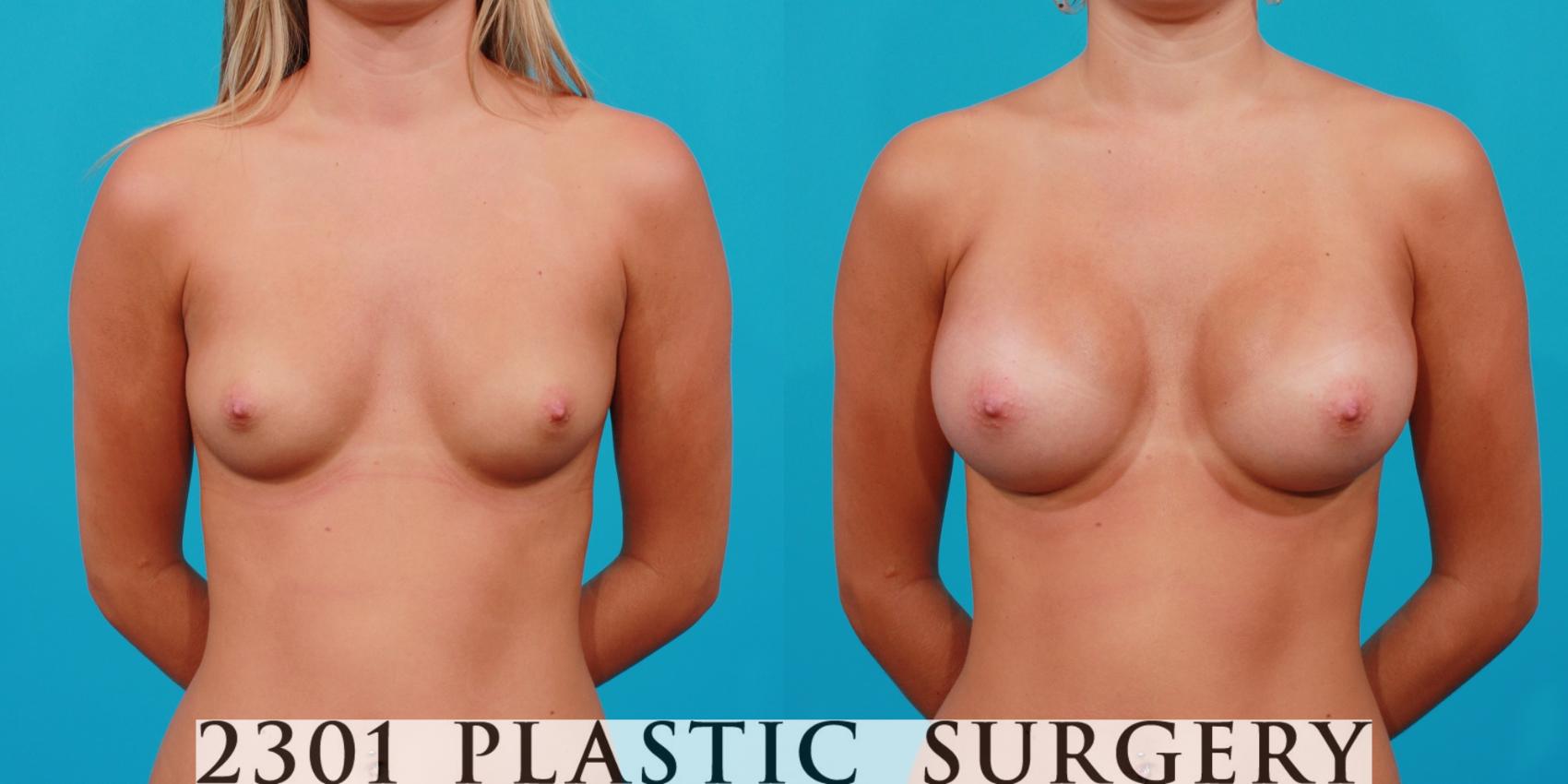 Before & After Saline Implants Case 143 View #1 View in Fort Worth & Frisco, Texas