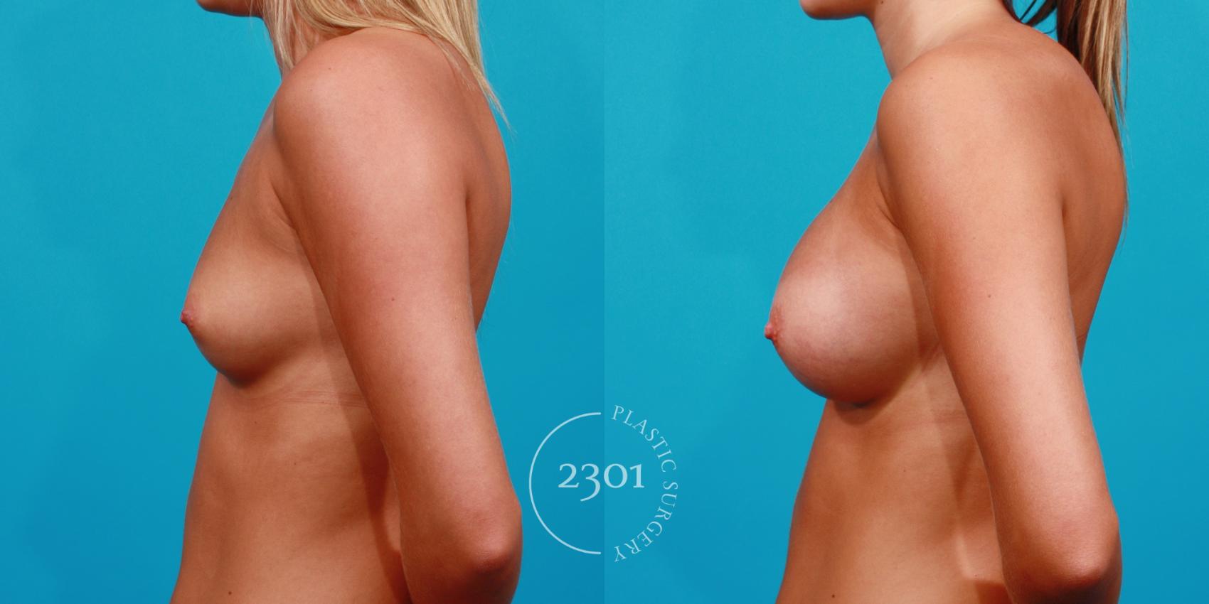 Before & After Saline Implants Case 143 View #2 View in Fort Worth, Plano, & Frisco, Texas