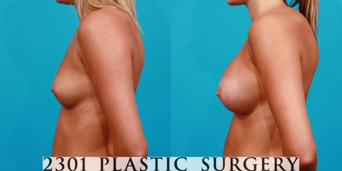 Before & After Saline Implants Case 143 View #2 View in Fort Worth, Plano, & Frisco, Texas
