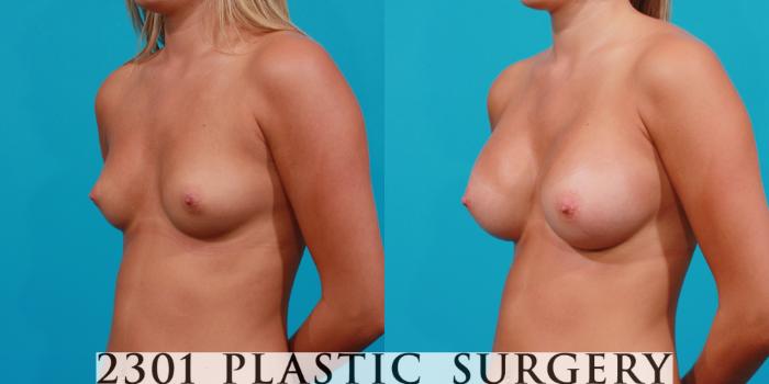 Before & After Saline Implants Case 143 View #3 View in Fort Worth, Plano, & Frisco, Texas
