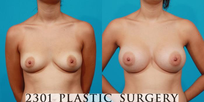 Before & After Saline Implants Case 150 View #1 View in Fort Worth, Plano, & Frisco, Texas