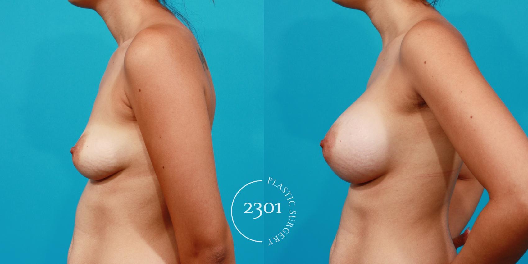 Before & After Saline Implants Case 150 View #2 View in Fort Worth, Plano, & Frisco, Texas