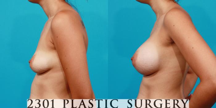 Before & After Saline Implants Case 150 View #2 View in Fort Worth, Plano, & Frisco, Texas