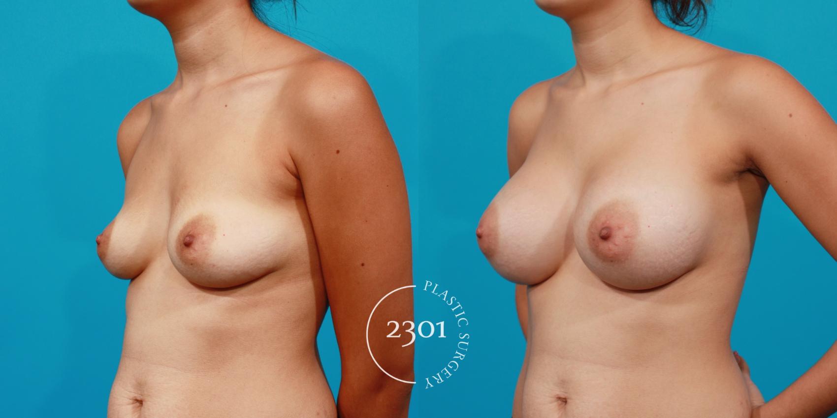 Before & After Saline Implants Case 150 View #3 View in Fort Worth, Plano, & Frisco, Texas